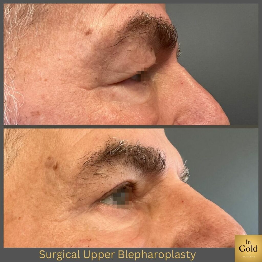 Surgical Upper Blepharoplasty03