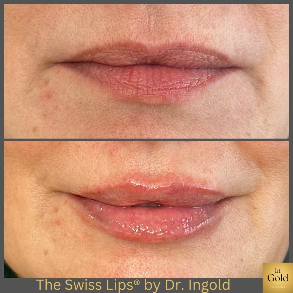 The Swiss Lips®️ By Dr. Ingold Zw