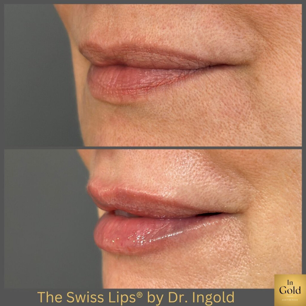 The Swiss Lips®️ By Dr. Ingold 1