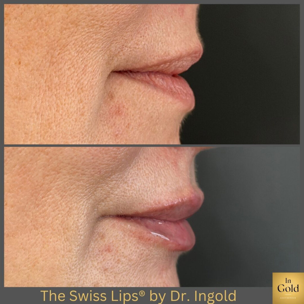 The Swiss Lips®️ By Dr. Ingold 1