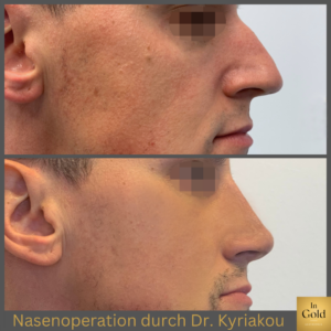 Nasenoperation Durch Drk