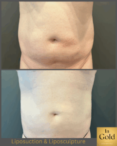 Liposuction&liposculpture1neu