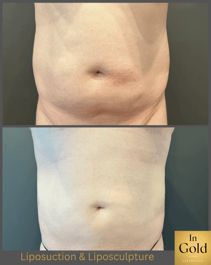 Liposuction&liposculpture1neu