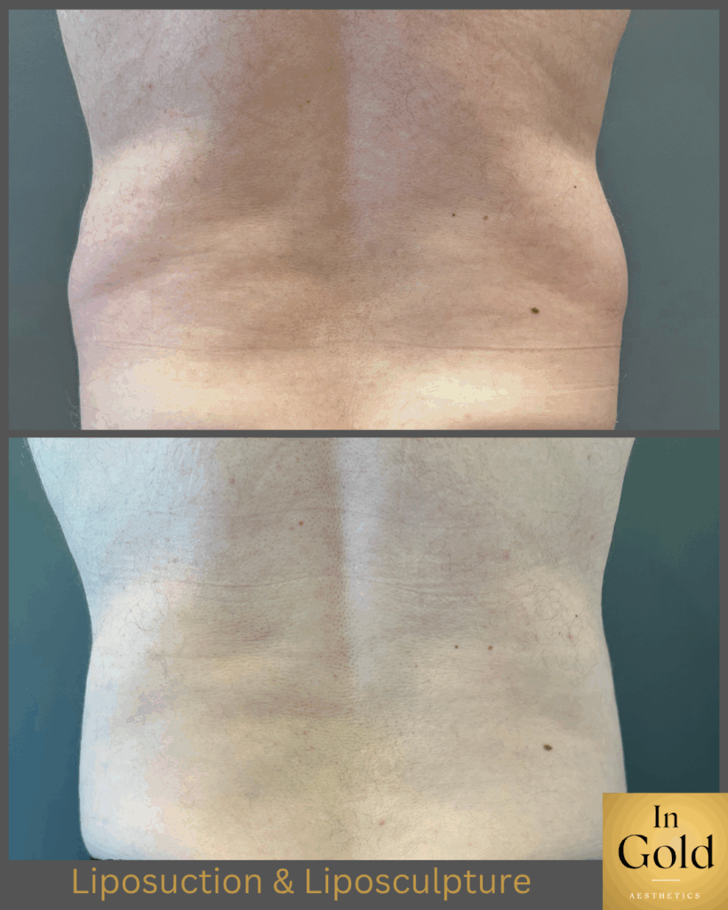 Liposuction&liposculpture2